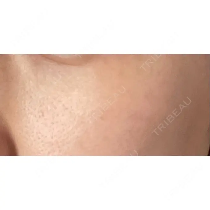 シミ取りレーザー / ピコレーザートーニング（美白・肝斑） PICO BEAUTY CLINIC DAY 8 メイン用