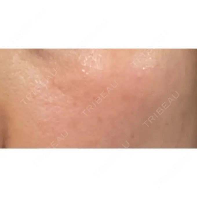 シミ取りレーザー / ピコレーザートーニング（美白・肝斑） PICO BEAUTY CLINIC AFTER メイン用