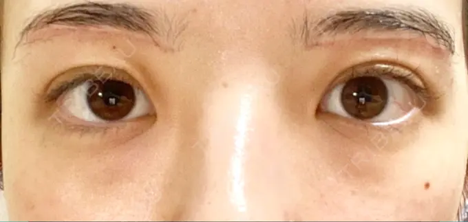 眉下切開 Taide Suenaga Clinic（タイデスエナガクリニック） DAY 74 メイン用