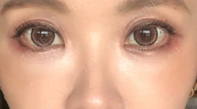 クマ治療 / 下まぶたたるみ取り / 下まぶたの脂肪取り 湘南美容クリニック 橋本院 DAY 12 メイン用