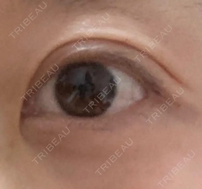 眼瞼下垂（切開） 銀座すみれの花 形成クリニック AFTER メイン用