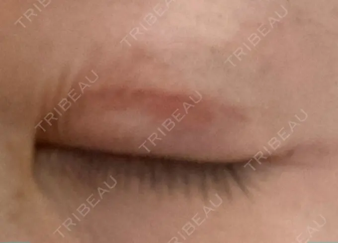 眼瞼下垂（切開） 銀座すみれの花 形成クリニック DAY 64 メイン用