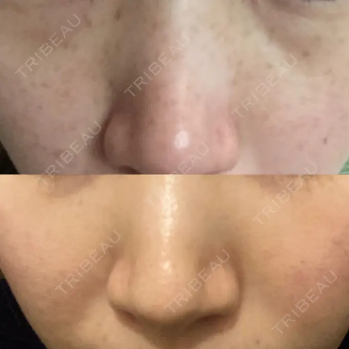 シミ取りレーザー 仁愛クリニック AFTER メイン用