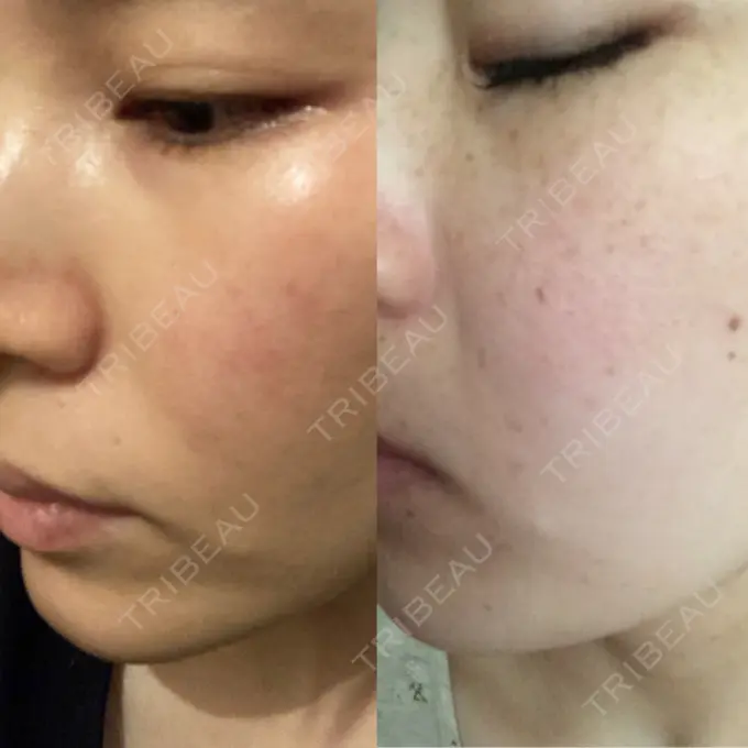 シミ取りレーザー 仁愛クリニック DAY 798 メイン用