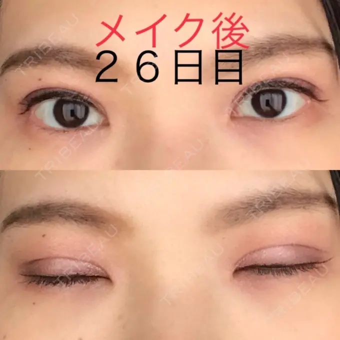 二重切開 / 上まぶたたるみ取り / 上まぶたの脂肪取り 城本クリニック 豊橋院 DAY 26 メイン用