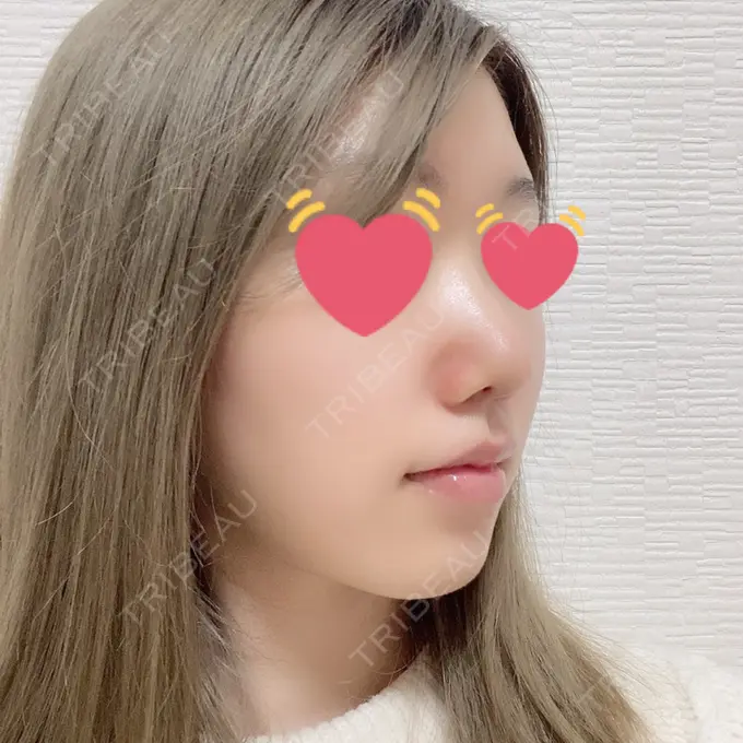 鼻尖形成（切開） / 軟骨移植 麹町皮ふ科・形成外科クリニック DAY 10 メイン用