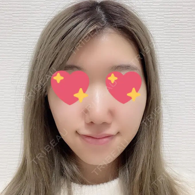 鼻尖形成（切開） / 軟骨移植 麹町皮ふ科・形成外科クリニック DAY 10 メイン用