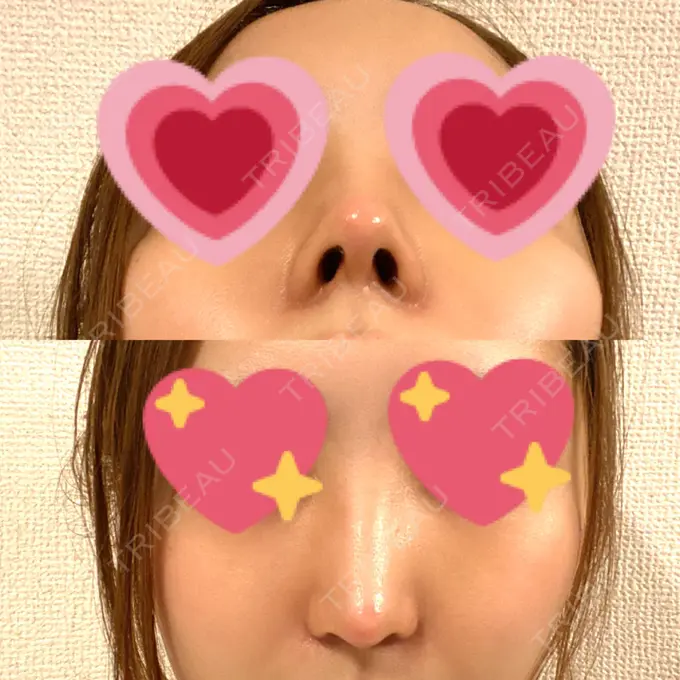 隆鼻術 / 鼻尖形成（切開） / 軟骨移植 / 骨切幅寄せ THE ROPPONGI CLINIC（ザ 六本木クリニック） DAY 12 メイン用