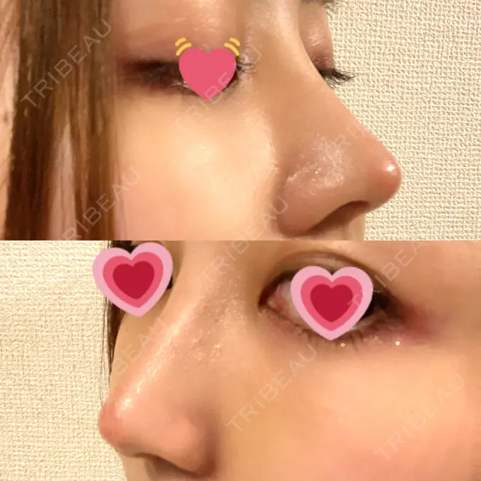 隆鼻術 / 鼻尖形成（切開） / 軟骨移植 / 骨切幅寄せ THE ROPPONGI CLINIC（ザ 六本木クリニック） DAY 12 メイン用