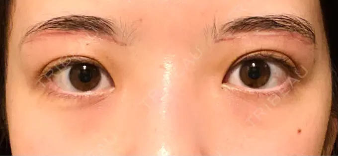 眉下切開 Taide Suenaga Clinic（タイデスエナガクリニック） DAY 76 メイン用