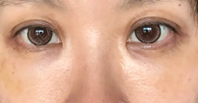 クマ治療 / 下まぶたたるみ取り / 下まぶたの脂肪取り 湘南美容クリニック 橋本院 DAY 12 メイン用