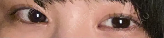 蒙古ひだ形成 R.O.clinic AFTER メイン用