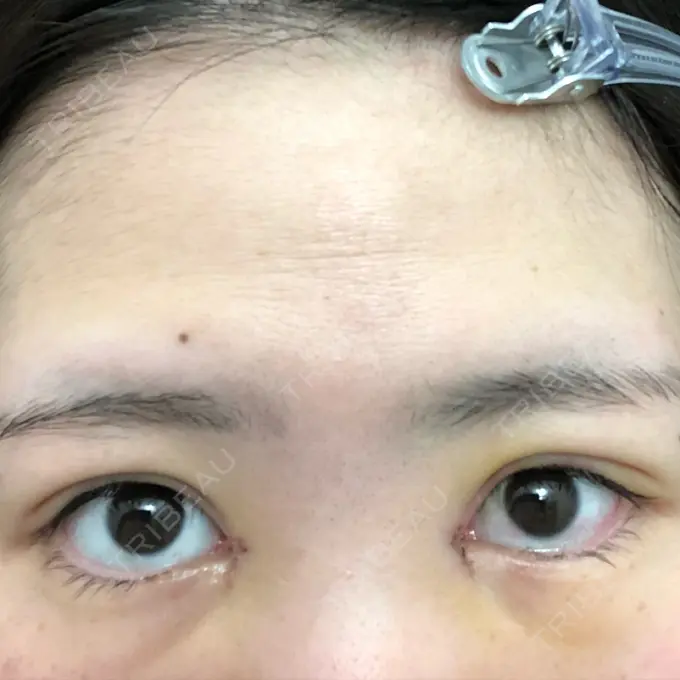 二重埋没 / 二重切開 / 矯正（ワイヤー） 湘南美容クリニック 橋本院 DAY 4 メイン用