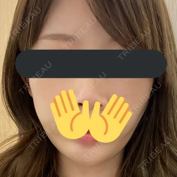 糸リフト / ヒアルロン酸注入（あご） ノーチェビューティクリニック DAY 2 メイン用