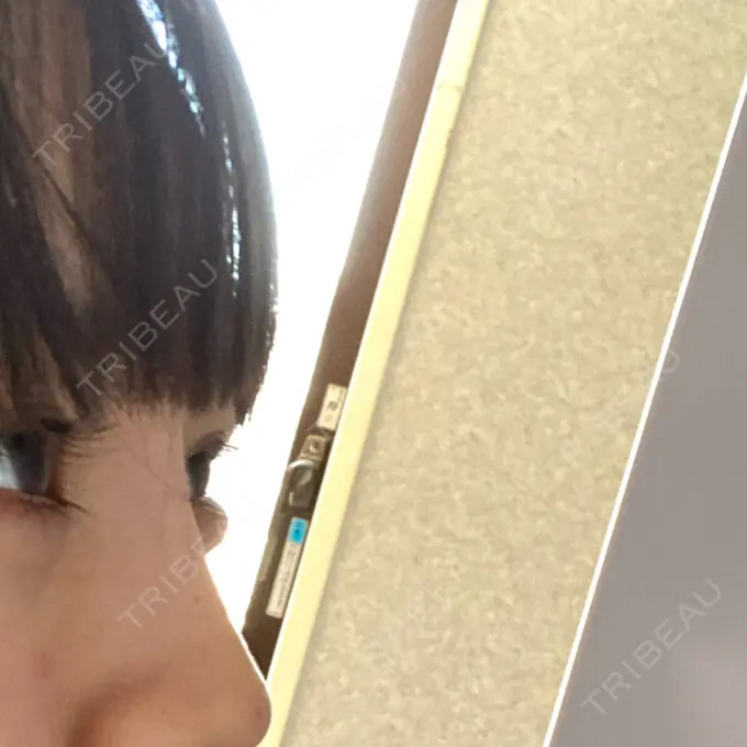 ヒアルロン酸注入（鼻） / ヒアルロン酸注入（あご） 神戸元町ビューティークリニック DAY 0 メイン用