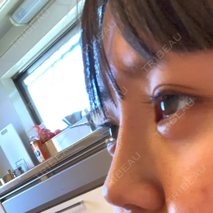 ヒアルロン酸注入（鼻） / ヒアルロン酸注入（あご） 神戸元町ビューティークリニック DAY 0 メイン用