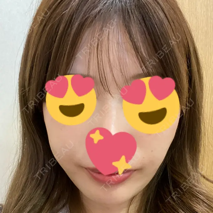 糸リフト / ヒアルロン酸注入（あご） ノーチェビューティクリニック DAY 4 メイン用