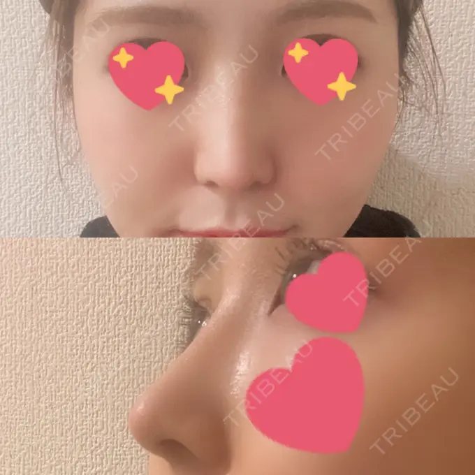 隆鼻術 / 鼻尖形成（切開） / 軟骨移植 / 骨切幅寄せ THE ROPPONGI CLINIC（ザ 六本木クリニック） DAY 17 メイン用