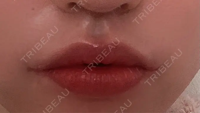 口角挙上 聖心美容クリニック 六本木院 DAY 354 メイン用