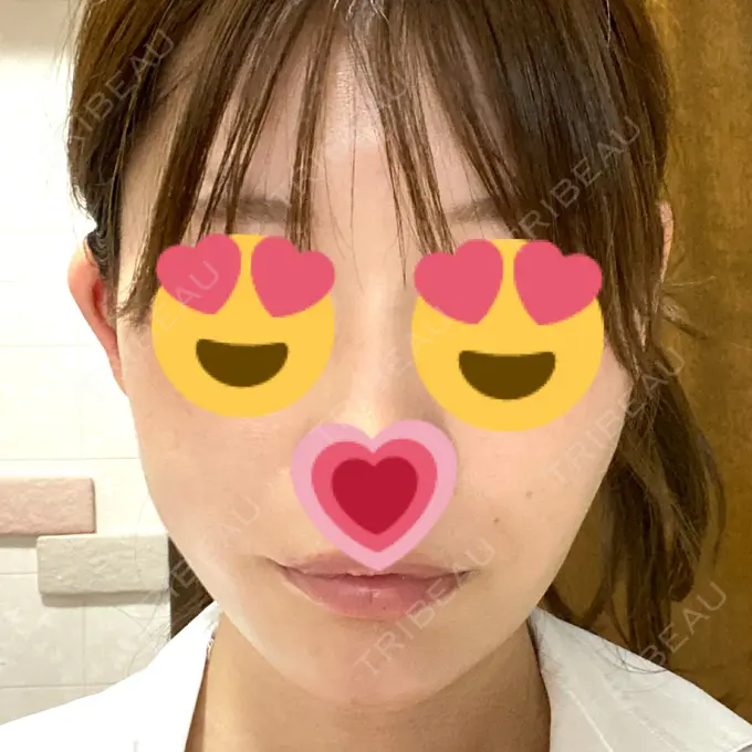 糸リフト / ヒアルロン酸注入（あご） ノーチェビューティクリニック DAY 5 メイン用