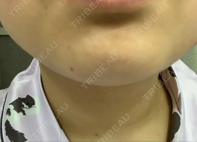 ボトックス（あご） / ボトックス（エラ・小顔） 湘南美容クリニック 名古屋栄院 DAY 4 メイン用