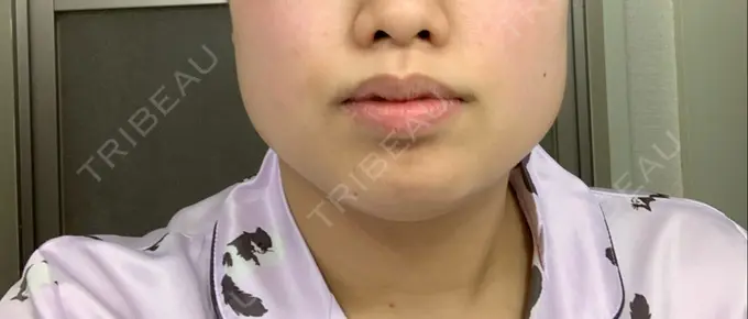 ボトックス（あご） / ボトックス（エラ・小顔） 湘南美容クリニック 名古屋栄院 DAY 4 メイン用