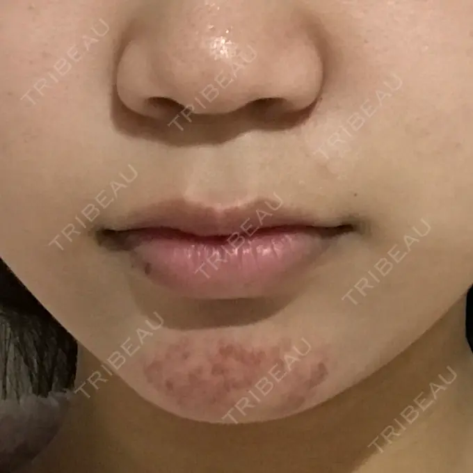 あごプロテーゼ 北尾クリニック DAY 17 メイン用