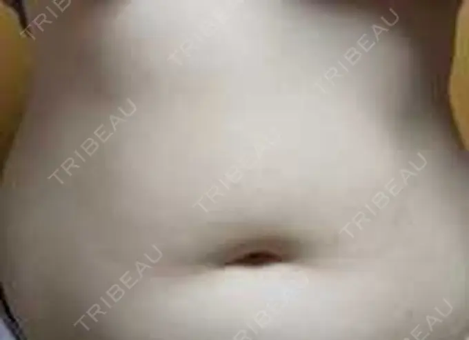 脂肪冷却（お腹） Dual Clinic SHINSAIBASHI DAY 16 メイン用