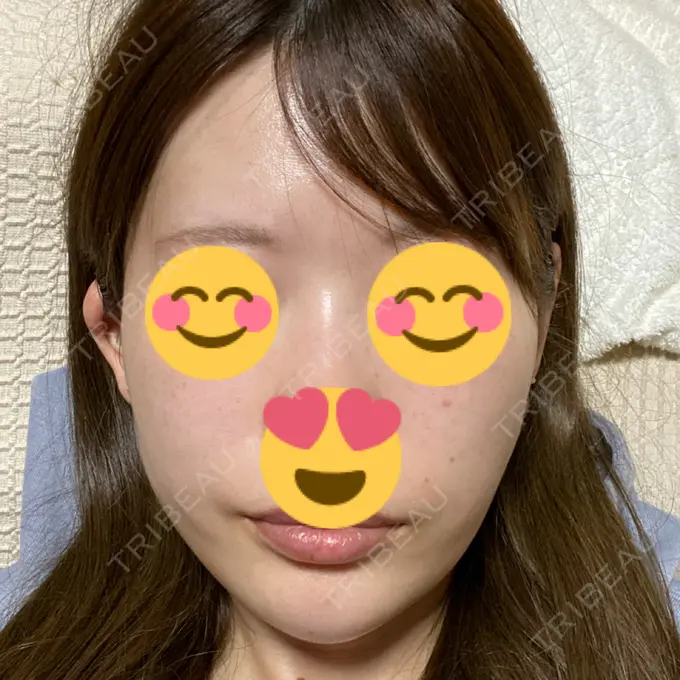 糸リフト / ヒアルロン酸注入（あご） ノーチェビューティクリニック DAY 6 メイン用