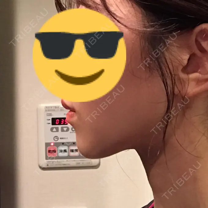 糸リフト / 脂肪吸引（顔） / ボトックス（あご） WOM CLINIC GINZA （ワム クリニック ギンザ） DAY 100 メイン用