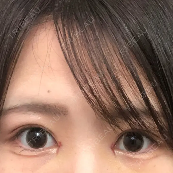 二重埋没 / 二重切開 / 矯正（ワイヤー） 湘南美容クリニック 橋本院 DAY 6 メイン用