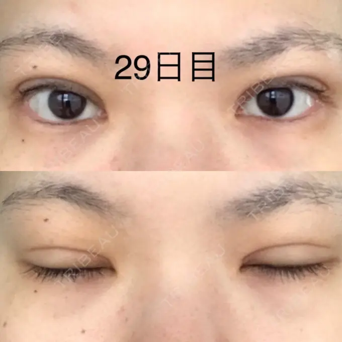 二重切開 / 上まぶたたるみ取り / 上まぶたの脂肪取り 城本クリニック 豊橋院 DAY 29 メイン用