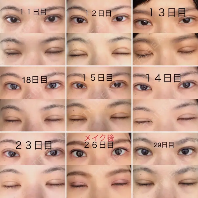 二重切開 / 上まぶたたるみ取り / 上まぶたの脂肪取り 城本クリニック 豊橋院 DAY 29 メイン用