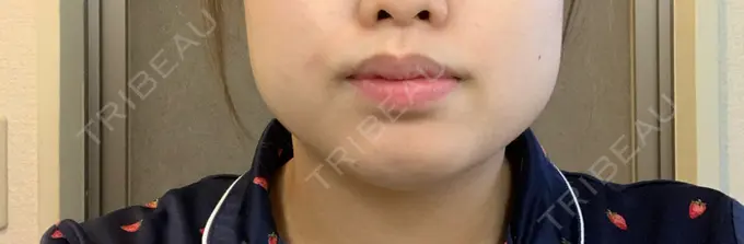 ボトックス（あご） / ボトックス（エラ・小顔） 湘南美容クリニック 名古屋栄院 DAY 7 メイン用