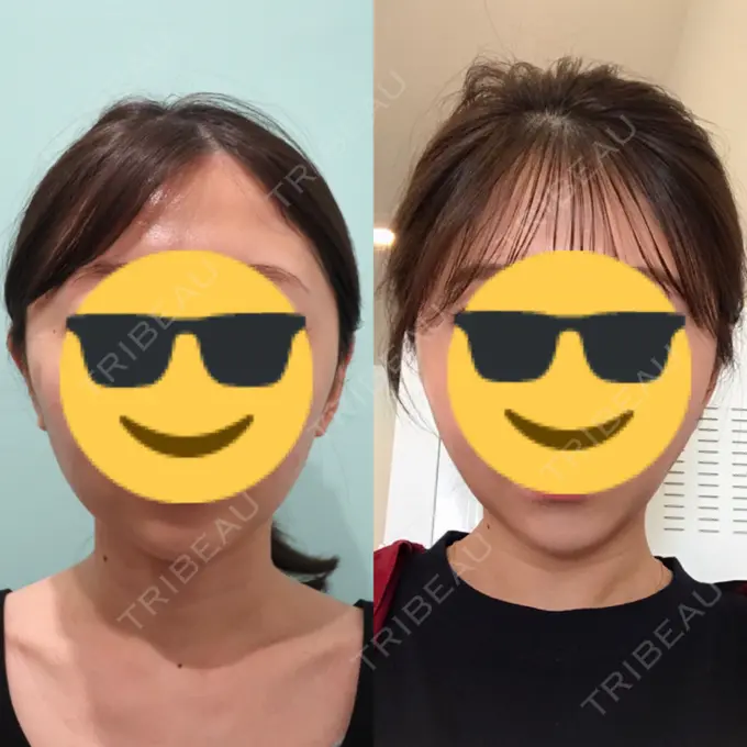 糸リフト / 脂肪吸引（顔） / ボトックス（あご） WOM CLINIC GINZA （ワム クリニック ギンザ） DAY 101 メイン用