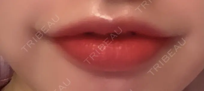 口角挙上 聖心美容クリニック 六本木院 AFTER メイン用