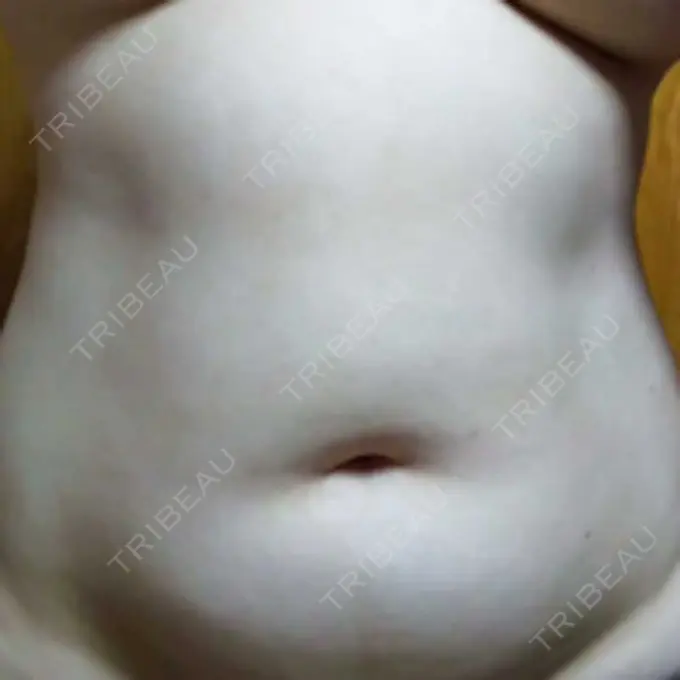 脂肪冷却（お腹） Dual Clinic SHINSAIBASHI DAY 20 メイン用