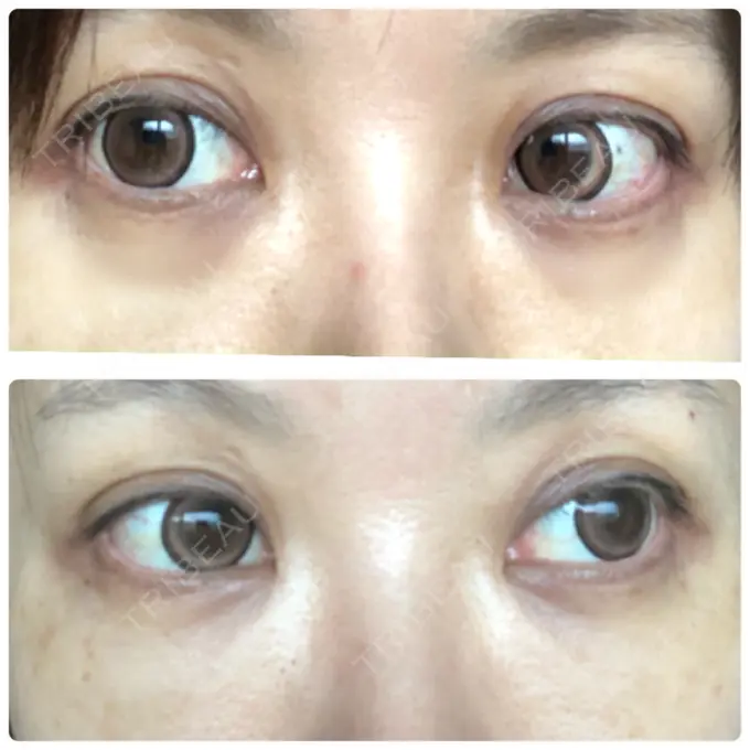 クマ治療 / 下まぶたたるみ取り / 下まぶたの脂肪取り 湘南美容クリニック 橋本院 DAY 20 メイン用