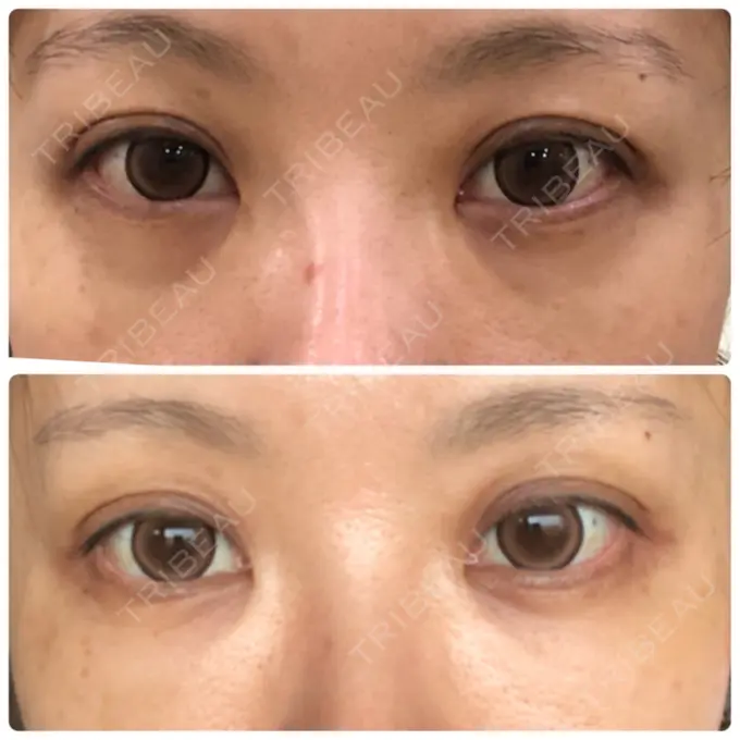 クマ治療 / 下まぶたたるみ取り / 下まぶたの脂肪取り 湘南美容クリニック 橋本院 DAY 20 メイン用