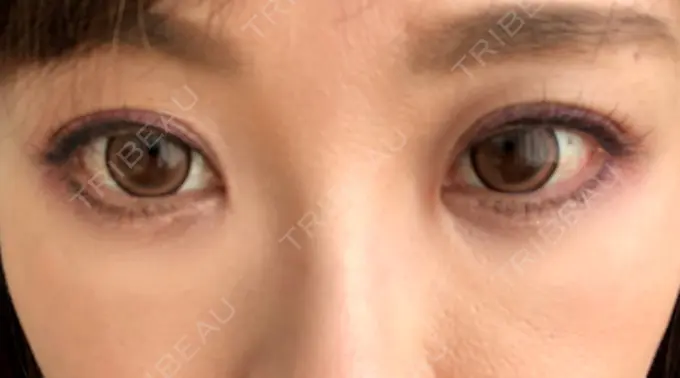 クマ治療 / 下まぶたたるみ取り / 下まぶたの脂肪取り 湘南美容クリニック 橋本院 DAY 24 メイン用