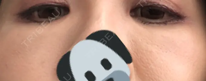 クマ治療 / 下まぶたたるみ取り / 下まぶたの脂肪取り 湘南美容クリニック 橋本院 DAY 24 メイン用