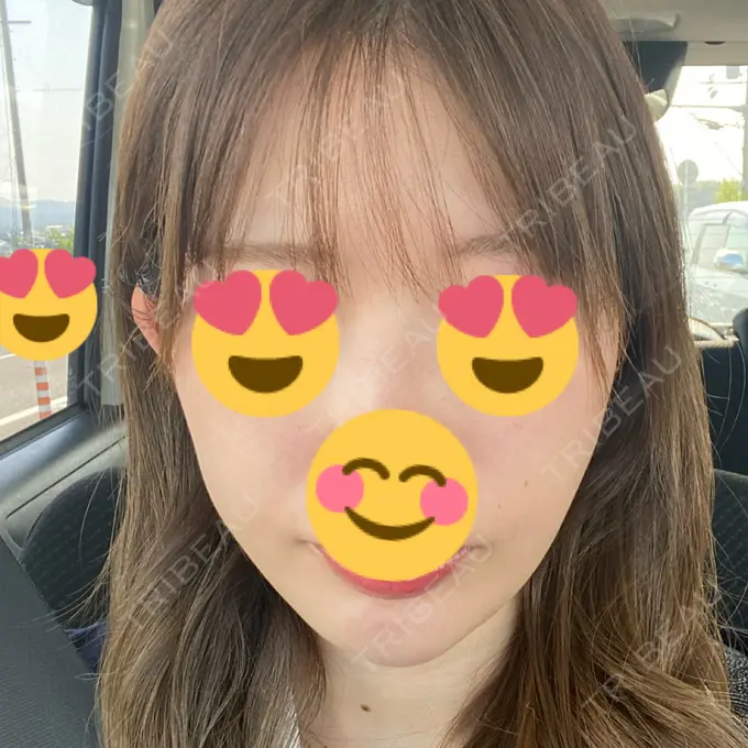 糸リフト / ヒアルロン酸注入（あご） ノーチェビューティクリニック DAY 11 メイン用