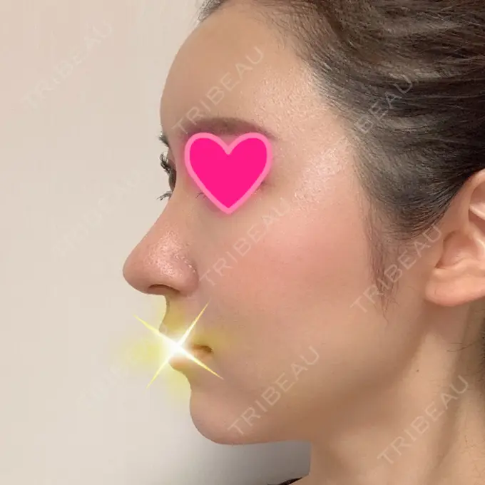 隆鼻術 / 鼻尖形成（切開） / 鼻中隔延長（切開） / 軟骨移植 / 鼻孔縁下降 Zetith Beauty Clinic 銀座院 DAY 93 メイン用