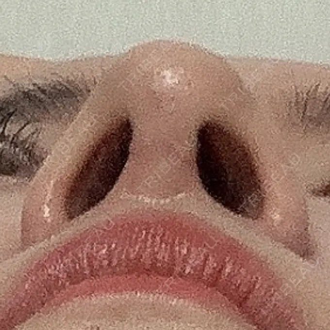 隆鼻術 / 鼻尖形成（切開） / 鼻中隔延長（切開） / 軟骨移植 / 鼻孔縁下降 Zetith Beauty Clinic 銀座院 DAY 93 メイン用