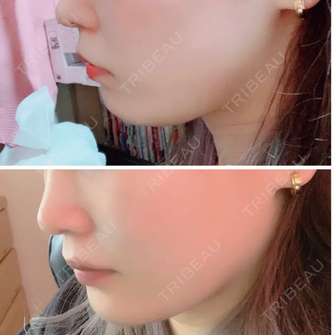 ボトックス（エラ・小顔） / その他（輪郭） 東京形成美容外科 船橋院 DAY 4 メイン用