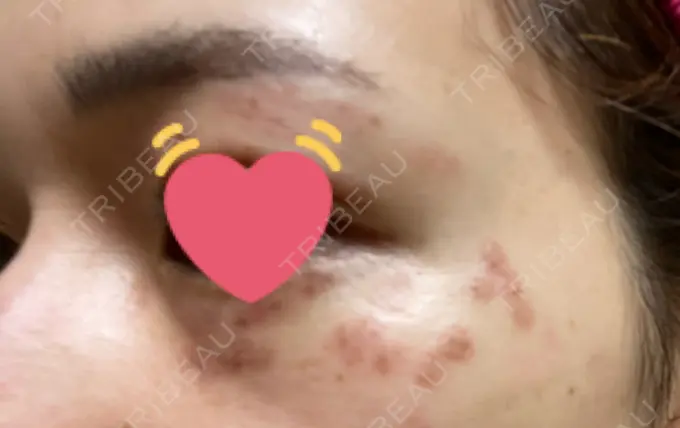 シミ取りレーザー / ピコレーザートーニング（美白・肝斑） ルラ美容クリニック 高田馬場院 DAY 4 メイン用