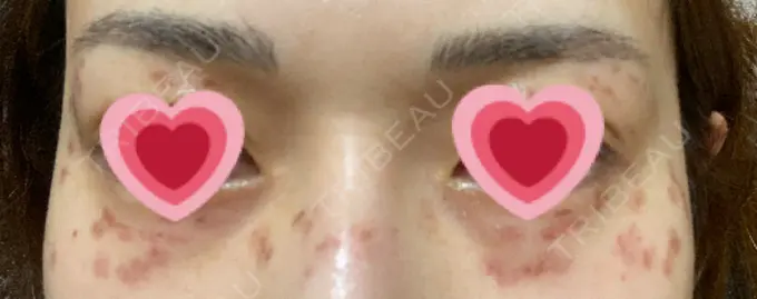 シミ取りレーザー / ピコレーザートーニング（美白・肝斑） ルラ美容クリニック 高田馬場院 DAY 6 メイン用