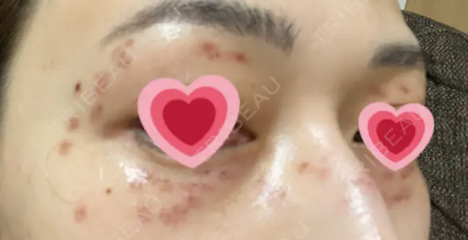 シミ取りレーザー / ピコレーザートーニング（美白・肝斑） ルラ美容クリニック 高田馬場院 DAY 7 メイン用