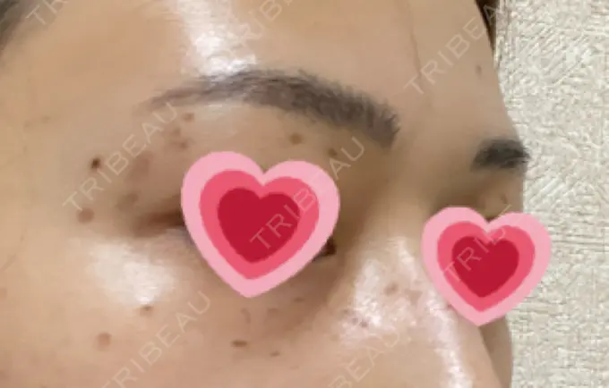 シミ取りレーザー / ピコレーザートーニング（美白・肝斑） ルラ美容クリニック 高田馬場院 DAY 9 メイン用