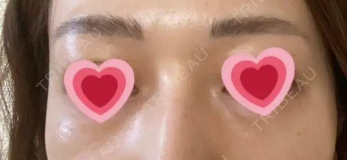 シミ取りレーザー / ピコレーザートーニング（美白・肝斑） ルラ美容クリニック 高田馬場院 AFTER メイン用